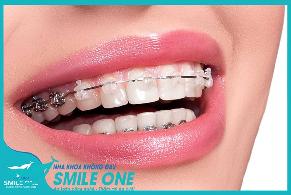 niềng răng mắc cài sứ hà nội