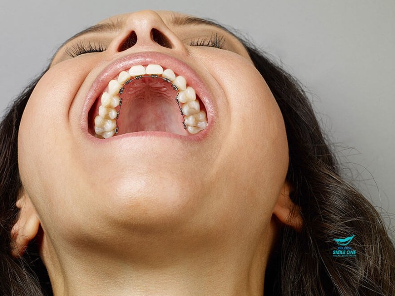 Mắc cài được giấu kín đáo phía sau răng, không gây ảnh hưởng đến vẻ ngoài và nụ cười của bạn trong suốt quá trình điều trị.