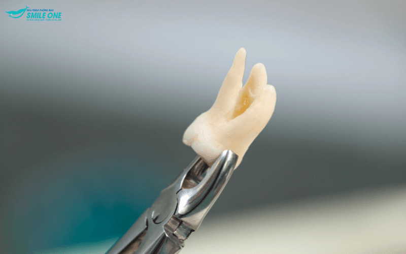 một số trường hợp khách hàng cần phải nhổ răng