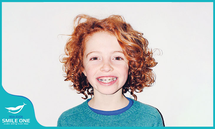 nièng răng cho trẻ em