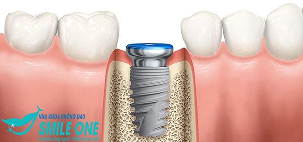 cac-buoc-cay-ghep-implant-02