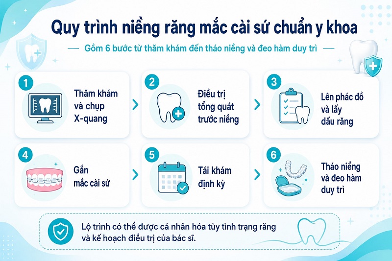 Quy trình niềng răng mắc cài sứ tại Smile One được thực hiện tuần tự qua 6 bước tiêu chuẩn