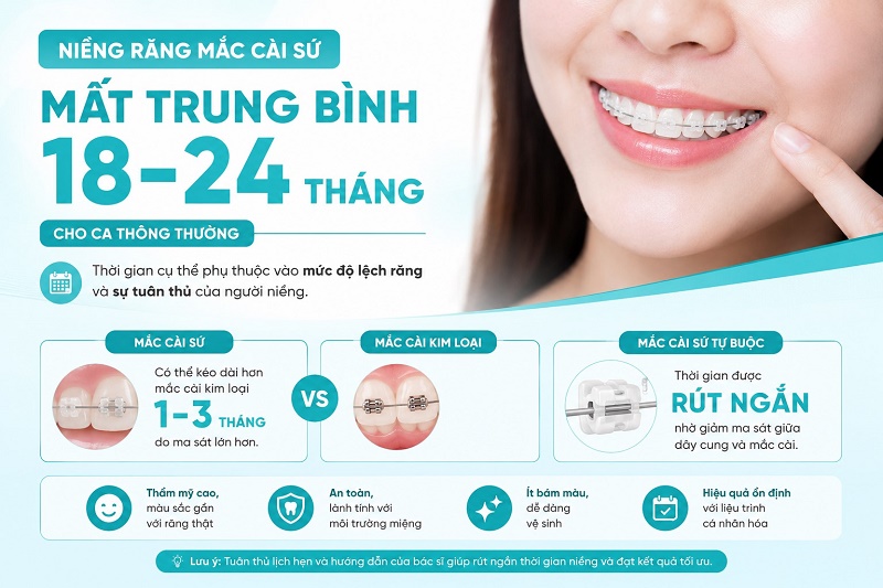Niềng răng mắc cài sứ mất trung bình 18-24 tháng cho ca thông thường