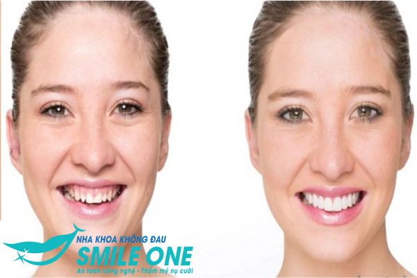 cười hở lợi phẫu thuật