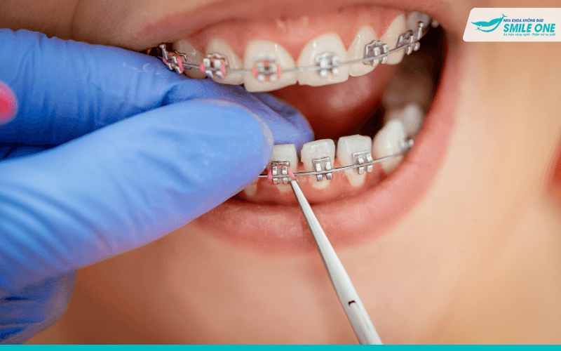 Răng thưa có nên niềng răng không? - Bác sĩ giải đáp 4