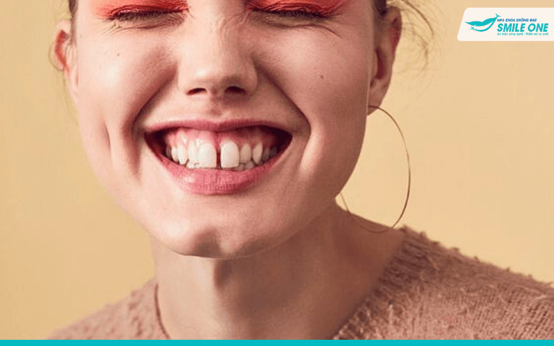 Răng thưa có nên niềng răng không? - Bác sĩ giải đáp 1