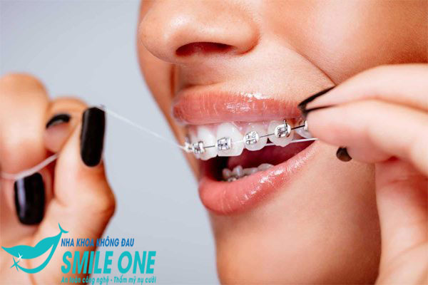 niềng răng dùng bàn chải gì