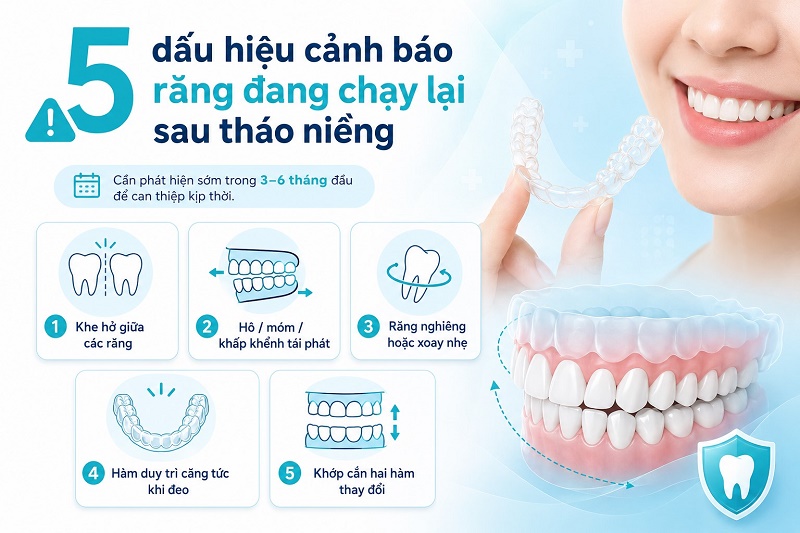 Có 5 dấu hiệu cảnh báo răng đang chạy lại cần phát hiện sớm trong 3-6 tháng đầu sau tháo niềng: khe hở giữa các răng, hô/móm/khấp khểnh tái phát, răng nghiêng hoặc xoay nhẹ, hàm duy trì căng tức khi đeo, và khớp cắn hai hàm thay đổi.