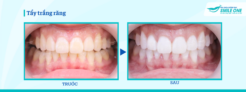 TOP 5 cách làm trắng răng hiệu quả - Bạn nên áp dụng ngay 3