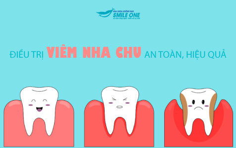 Điều trị viêm nha chu an toàn, hiệu quả
