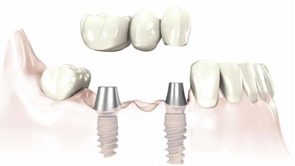 trong-rang-implant-co-dau-khong-1