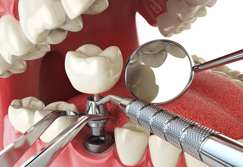 Tác hại và rủi ro của việc trồng implant