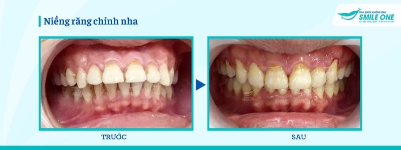 Hiệu quả niềng răng Leetray trước và sau