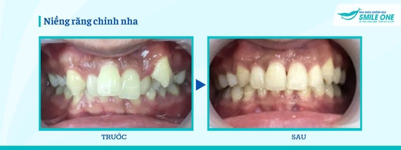 Các loại niềng răng trong suốt giúp chỉnh răng hiệu quả 6
