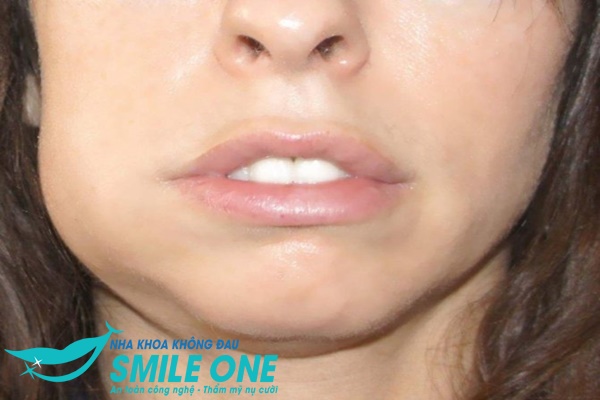 sau-khi-nho-rang-khon-bi-nhiem-trung-03