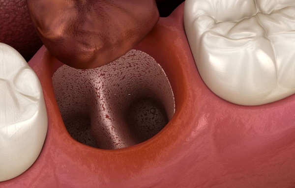 Viêm ổ răng khô là gì? Viêm ổ răng khô có nguy hiểm không?