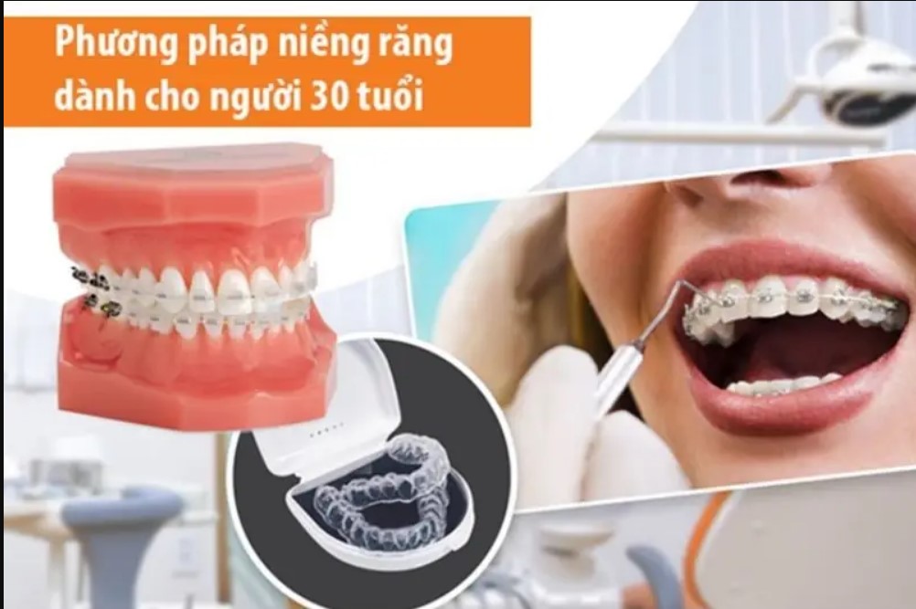 So sánh các phương pháp niềng răng cho người 30 tuổi: mắc cài kim loại, mắc cài sứ và khay trong suốt Invisalign.