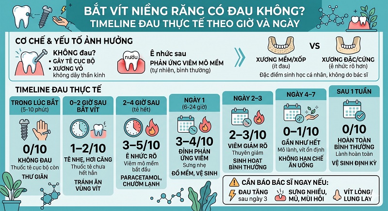 Biểu đồ timeline mức độ đau khi bắt vít niềng răng: Trong lúc bắt (không đau nhờ thuốc tê); 2-4 giờ sau (ê nhức nhẹ); sau vài ngày đến 1 tuần (hoàn toàn bình thường).