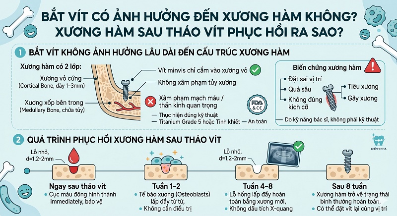 Đồ họa giải phẫu cho thấy minivis chỉ cắm vào lớp xương vỏ, không xâm phạm tủy răng. Sau khi tháo vít, lỗ chân vít nhỏ sẽ được lấp đầy bằng tế bào xương mới và lành hẳn mà không để lại dấu vết.