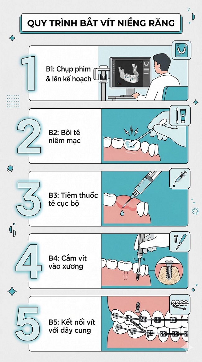 Sơ đồ quy trình bắt vít niềng răng gồm 5 bước: 1. Chụp phim và lên kế hoạch; 2. Bôi tê niêm mạc; 3. Tiêm tê cục bộ; 4. Cắm vít vào xương (5-10 phút); 5. Kết nối vít với dây cung để bắt đầu kéo răng.