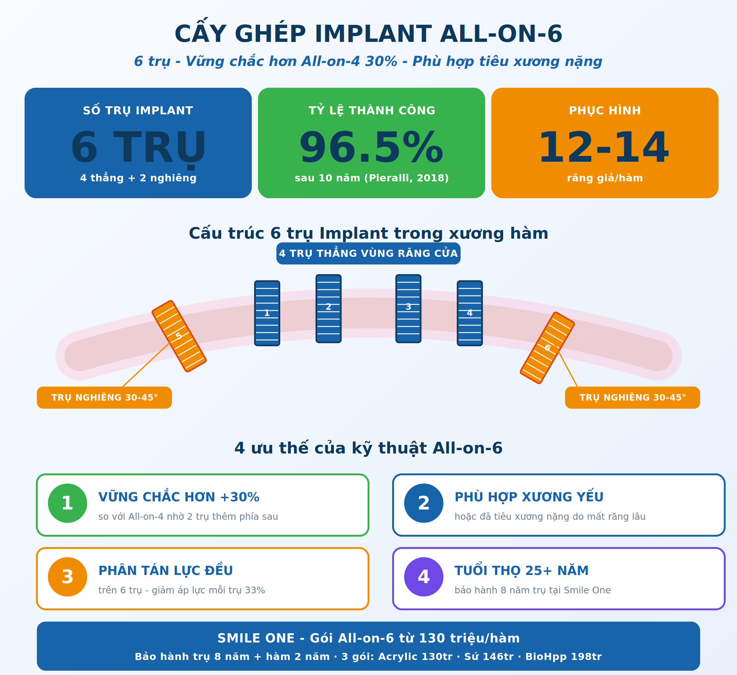 Cấy ghép Implant All-on-6 phục hình toàn hàm tại Smile One
