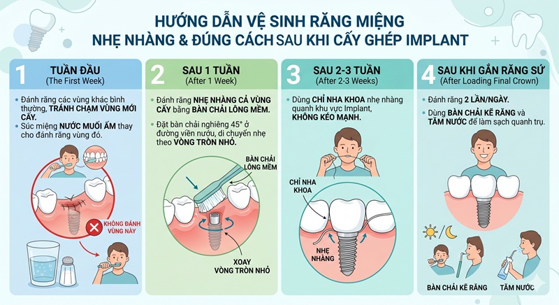 9 bước chăm sóc răng sau khi cắm implant