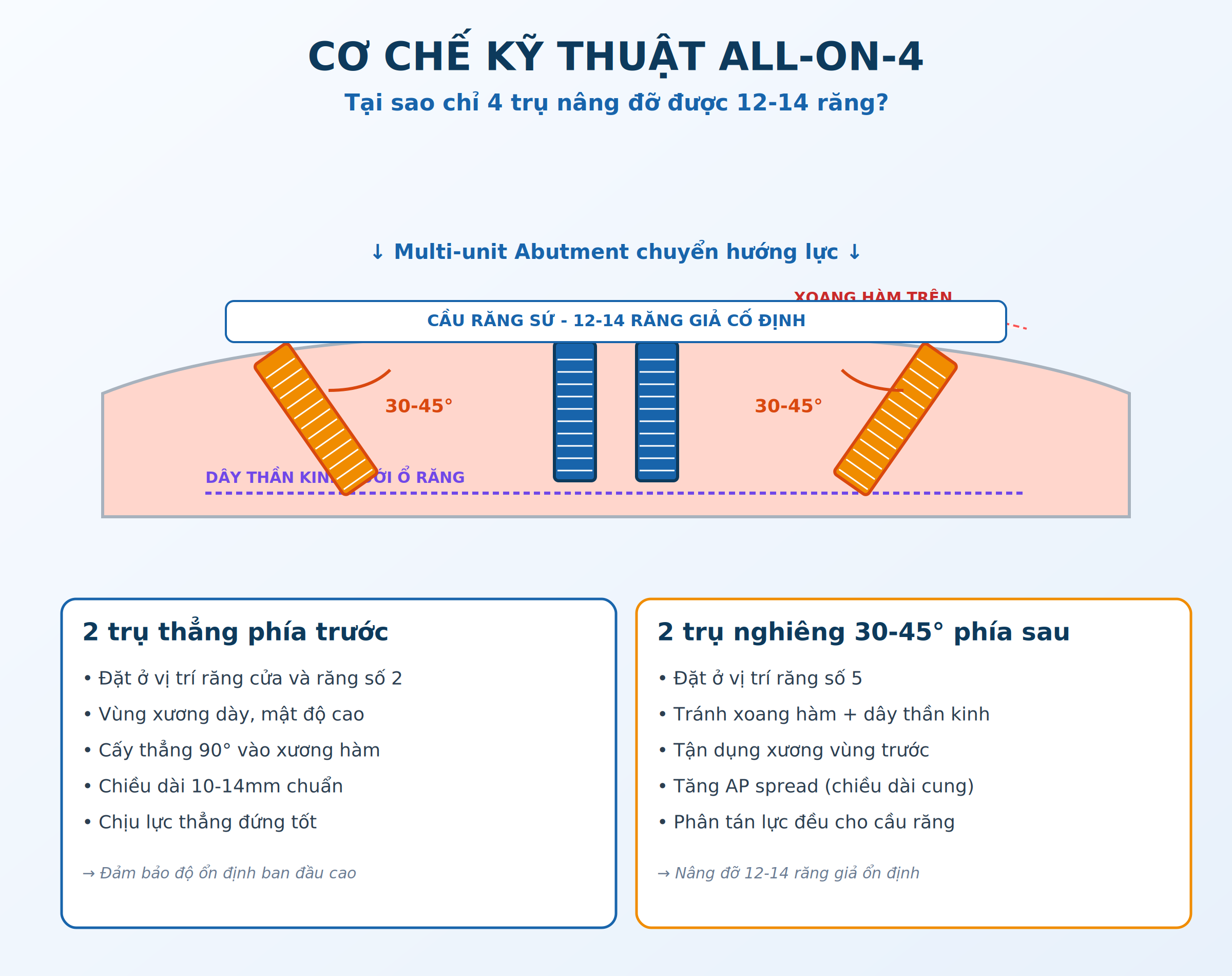 Cơ chế kỹ thuật All-on-4 với 2 trụ thẳng và 2 trụ nghiêng 30-45 độ