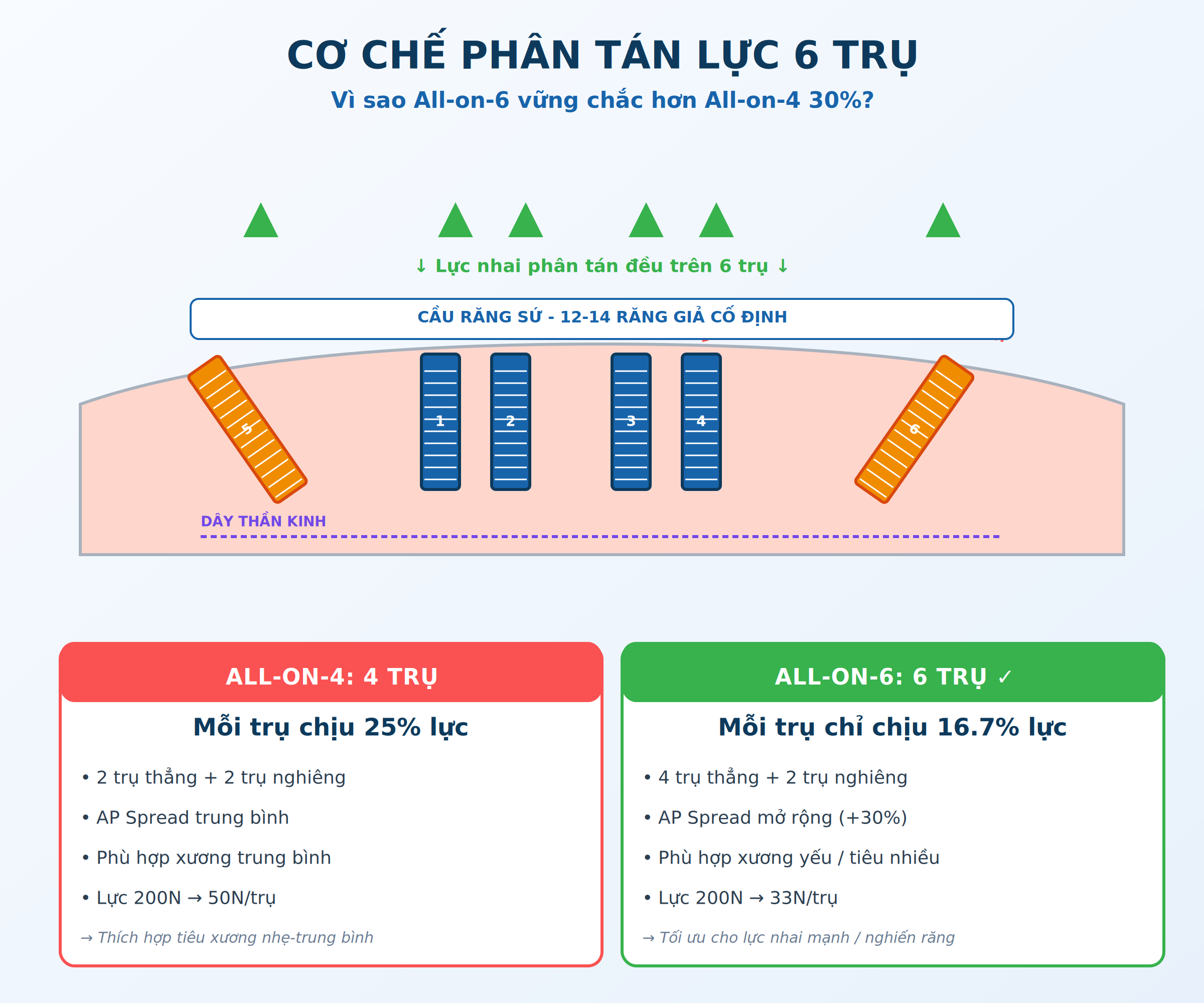 Cơ chế phân tán lực của 6 trụ implant trong All-on-6