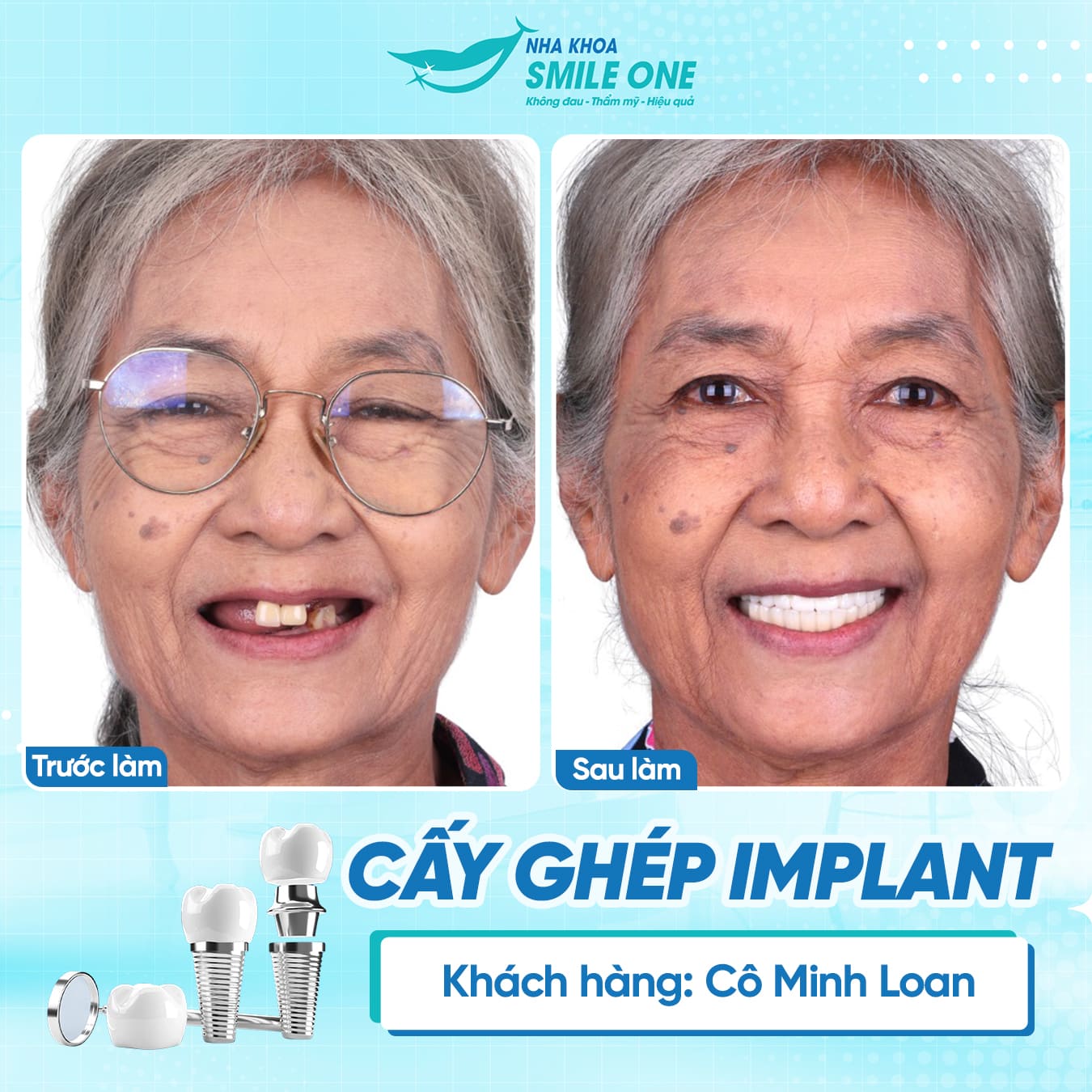 Cô Minh Loan hài lòng với kết quả trồng răng implant tại Nha khoa Smile One Biên Hòa