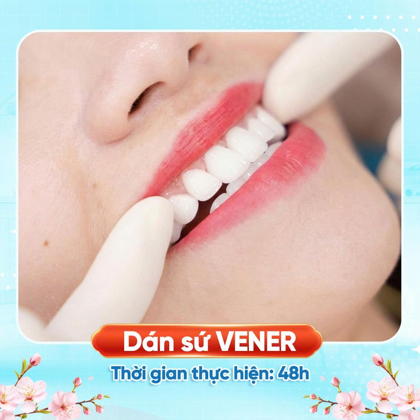 Khách hàng sau dán sứ, răng trắng, màu tự nhiên, tự tin với nụ cười rạng rỡ