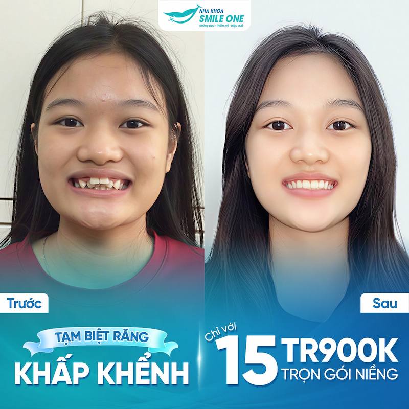 Minh Anh (sinh viên năm 3 tại khu vực Xuân Thủy) đến Smile One trong tình trạng răng khấp khểnh mức độ vừa, khớp cắn chưa chuẩn. Sau niềng răng đều, đẹp