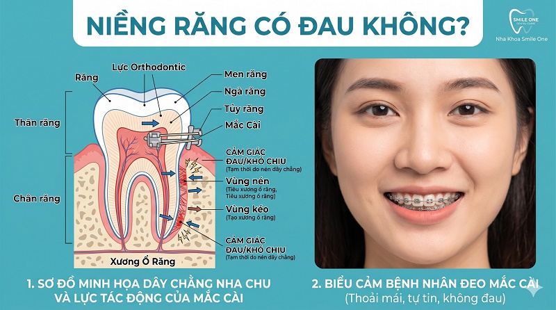 Niềng răng có đau không và đau giai đoạn nào