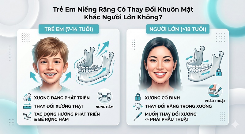 Hình ảnh so sánh cơ chế niềng răng ở trẻ em (7-14 tuổi) và người lớn (>18 tuổi). Ở trẻ em, xương đang phát triển nên có thể thay đổi cấu trúc xương thật và nong hàm. Ở người lớn, xương đã cố định, thay đổi chủ yếu diễn ra ở vị trí răng trong xương
