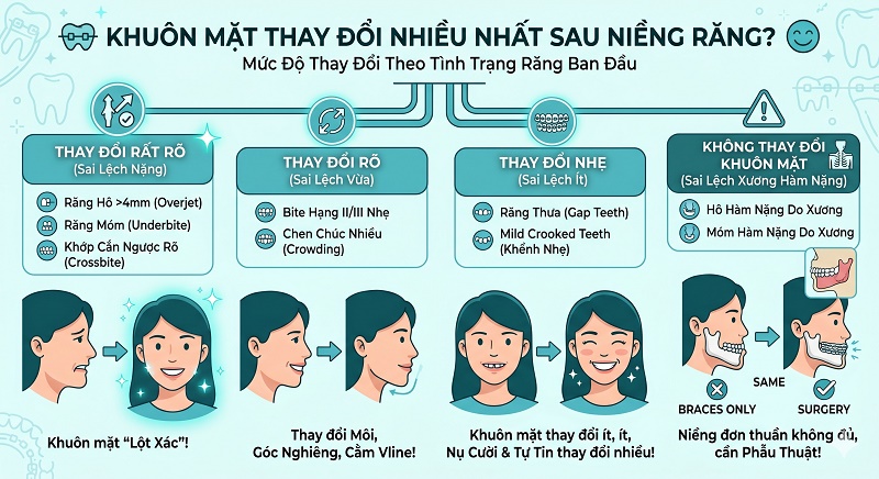Chi tiết 4 vùng khuôn mặt cải thiện sau niềng: Đôi môi thu vào tự nhiên (hết răng hô); Vùng cằm trông thon gọn V-line; Góc nghiêng có góc mũi-môi mở rộng tạo ảo giác mũi cao hơn; Cơ mặt thư giãn, tầng mặt dưới cân đối hơn