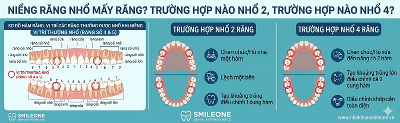 sơ đồ hàm răng đánh dấu vị trí các răng thường được nhổ và infographic so sánh 2 trường hợp nhổ 2 và nhổ 4 răng