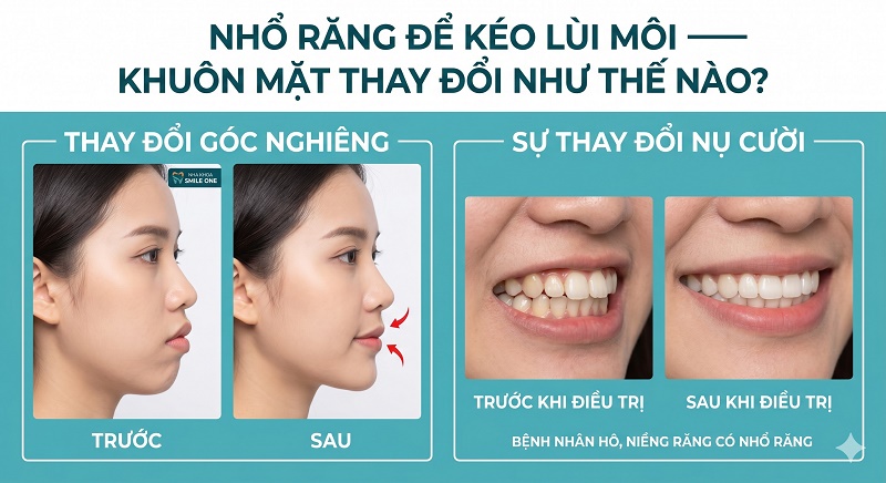 ảnh góc nghiêng mặt trước–sau kéo lùi môi thành công và ảnh before/after bệnh nhân hô được niềng có nhổ răng