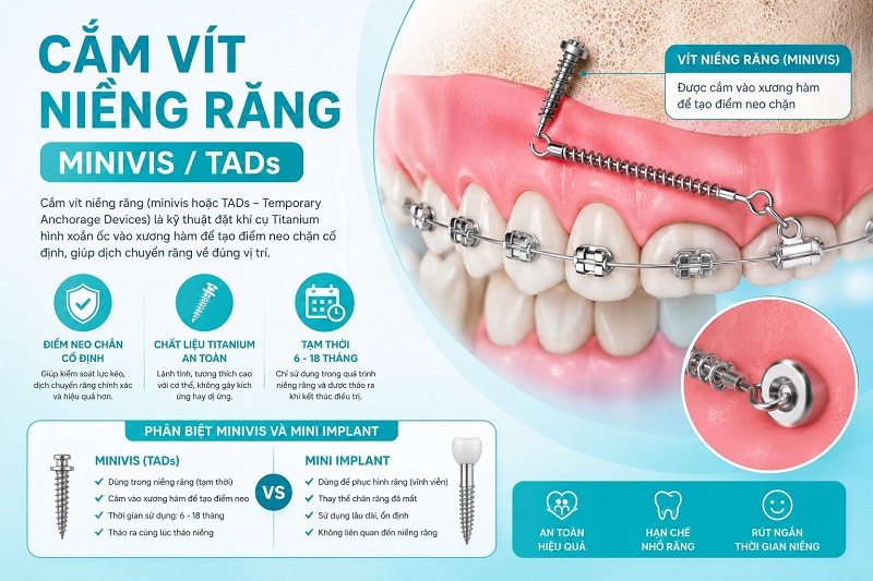 Cắm vít niềng răng không đau nhờ gây tê đầy đủ