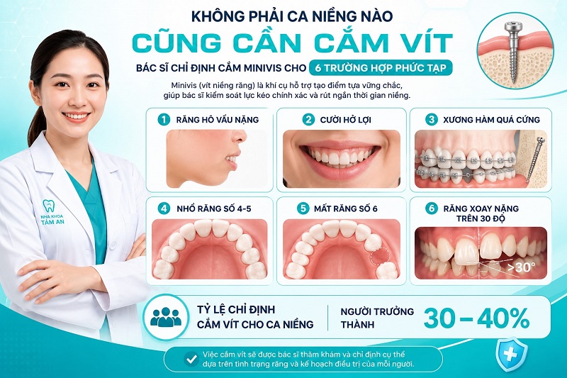 Các trường hợp cần cắm vít niềng răng