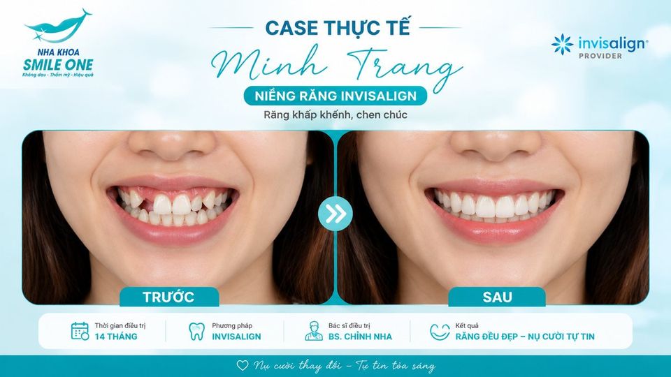 Tình trạng răng móm — hàm dưới đưa ra trước