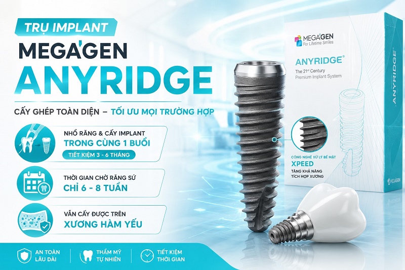 Các phương pháp cấy ghép implant