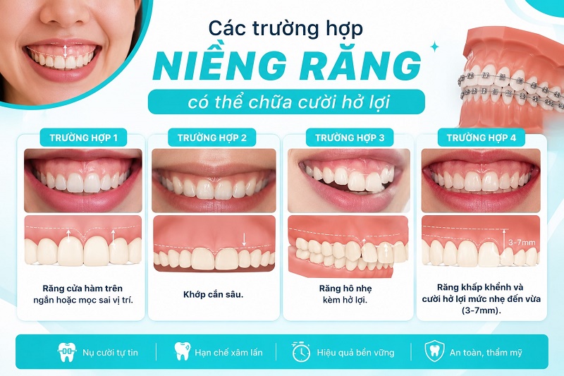 Trường hợp 1 — Răng cửa hàm trên ngắn hoặc mọc sai vị trí