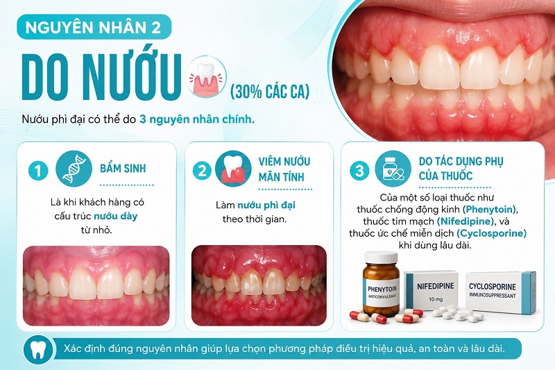 So sánh 3 phương pháp khắc phục cười hở lợi
