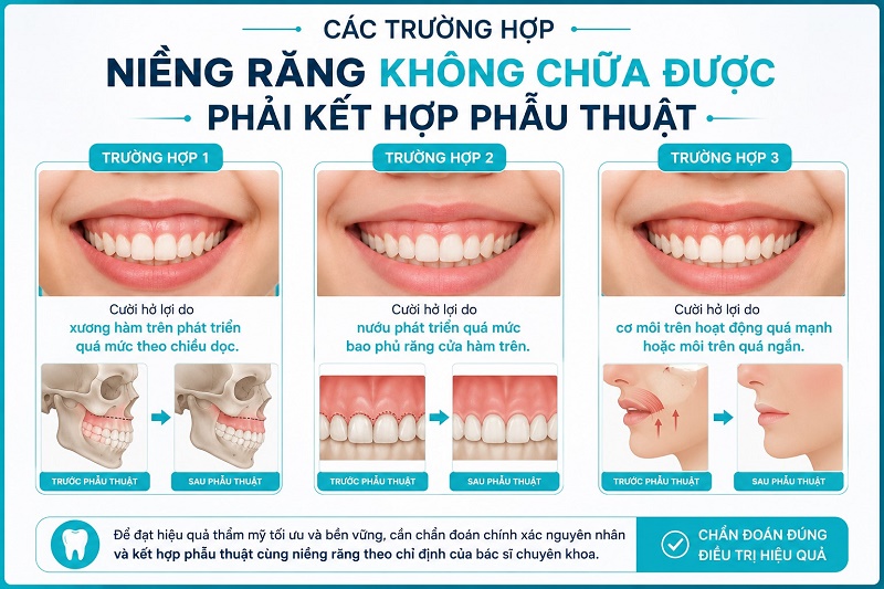 Các trường hợp niềng răng KHÔNG chữa được phải kết hợp phẫu thuật