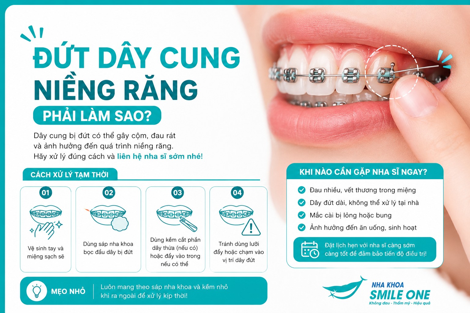 Đứt dây cung niềng răng là tình trạng khá phổ biến và cần được xử lý đúng cách