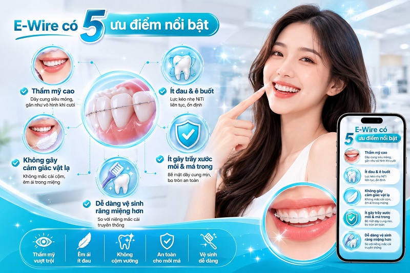 E-Wire có 5 ưu điểm nổi bật: thẩm mỹ cao vì dây cung siêu mỏng gần như vô hình khi cười, ít đau và ê buốt nhờ lực kéo nhẹ NiTi liên tục,