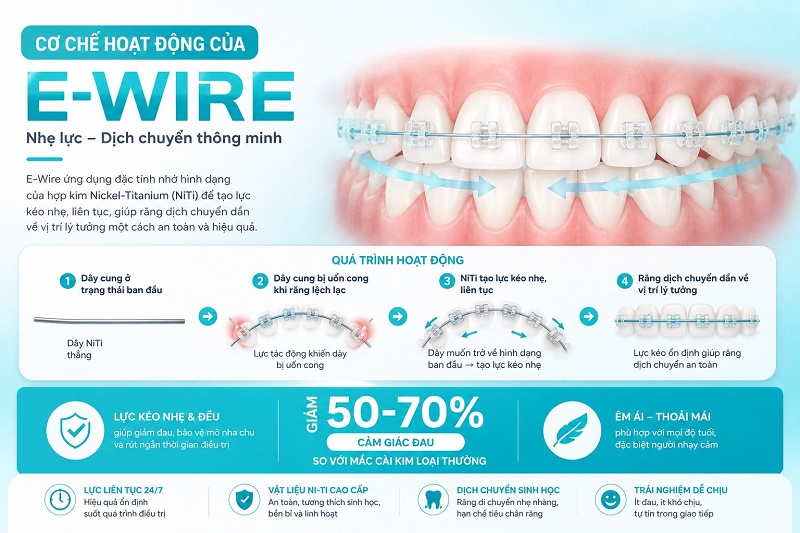 Cơ chế hoạt động của E-Wire dựa trên đặc tính nhớ hình dạng của hợp kim Nickel-Titanium.