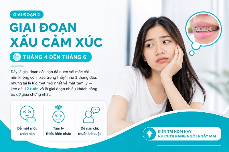 giai đoạn các bạn đã quen với mắc cài nên không còn "xấu trông thấy" như 3 tháng đầu