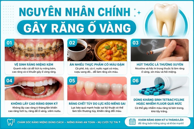 nguyên nhân chính gây răng ố vàng gồm vệ sinh răng miệng kém quanh mắc cài, ăn nhiều thực phẩm có màu đậm như cà phê và cà ri