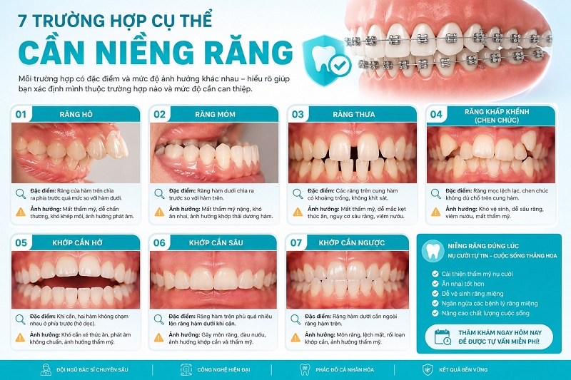 trường hợp cụ thể cần niềng răng gồm: răng hô, răng móm, răng thưa, răng khấp khểnh chen chúc