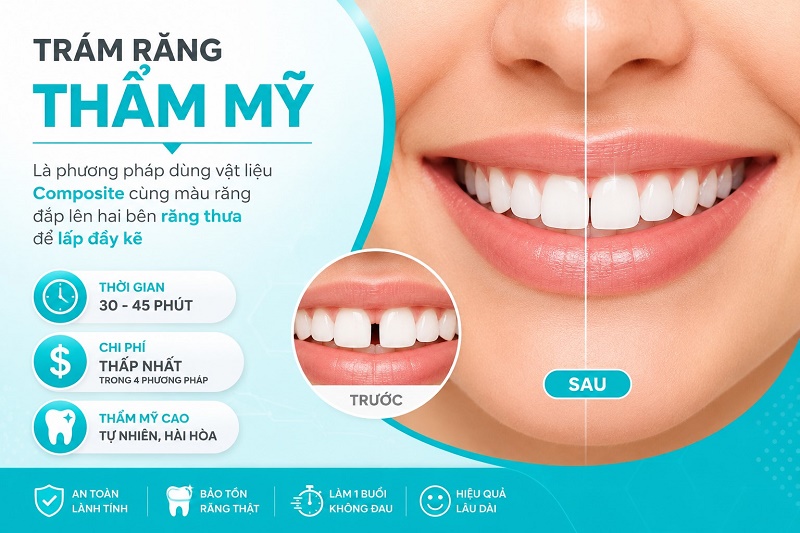 Trám răng thẩm mỹ là phương pháp dùng vật liệu Composite cùng màu răng